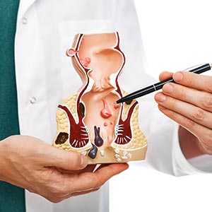 Anal Fistulas Surgery Near Me in Phoenix, AZ