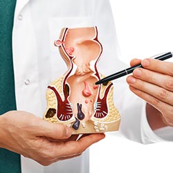 Anal Fistulas Surgery Near Me in Phoenix, AZ