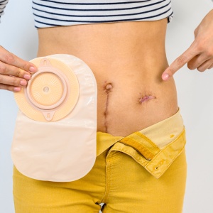 Colostomy Reversal in Phoenix, AZ