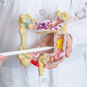 Colon Diverticulitis Treatment in Phoenix, AZ