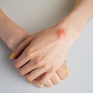 Lipomas and Common Skin Growths in Phoenix, AZ
