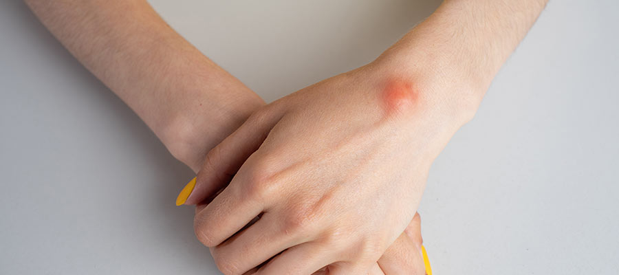 How Are Lipomas and Common Skin Growths Treated in Phoenix, AZ?